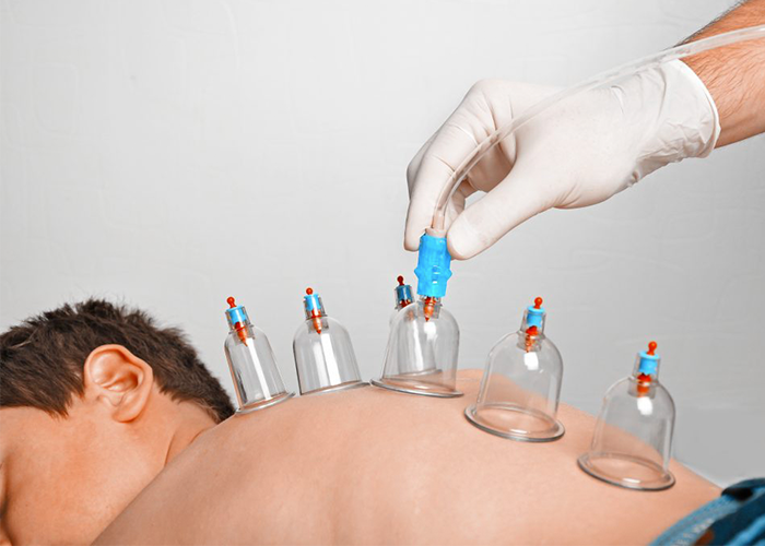 Hacamat Ne Zaman Yapılır? - İzmir Hacamat | Dr. Mehmet Özkent